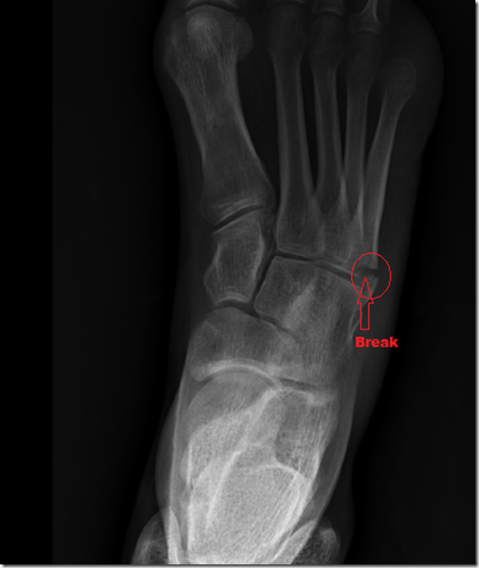 brokenfoot